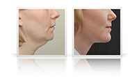  Neck lift,  neck contouring.