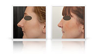 Primary open-tip reduction rhinoplasty.