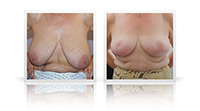 Breast Reduction.