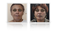 Facelift, neck lift, Bell's palsy.