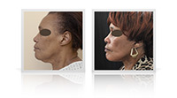 Facelift, neck lift, Bell's palsy.