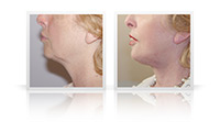 Facelift, neck lift, fat transfer.