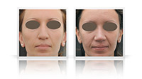 Correction of droopy nasal tip.