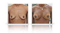 Breast augmentation, gel  implants, subpectoral  plane.