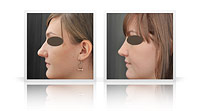 Primary open tip rhinoplasty, correction of nasal bump.