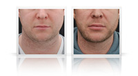 Buccal fat reduction, VASER liposelection, Anterior Neck lift.