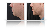 Buccal fat reduction, VASER liposelection, Anterior Neck lift.
