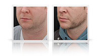 Buccal fat reduction, VASER liposelection, Anterior Neck lift.