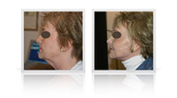 Facelift neck lift, fat transfer to midface.