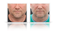  Anterior Neck lift