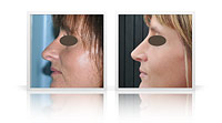 primary reduction rhinoplasty, nasal tip and bridge.