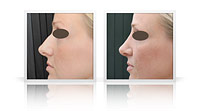 Correction of nasal bump.