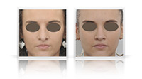 Reduction of the nasal bump, contouring of the tip of the nose.
