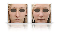 Reduction rhinoplasty, correction of the nasal bump.
