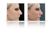 Reduction rhinoplasty, correction of the nasal bump.