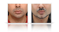 Facial sculpting, chin and jaw implants, anterior neck left.