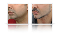 Facial sculpting, chin and jaw implants, anterior neck left.