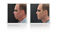 Anterior neck lift, chin implant.