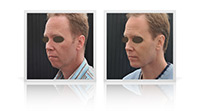 Anterior neck lift, chin implant.