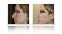 Reduction rhinoplasty, narrowing of the tip of the nose.