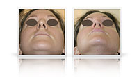Reduction rhinoplasty, narrowing of the tip of the nose.