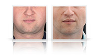 Buccal fat reduction, VASER Liposelection to cheeks, jawline and chin.