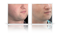 Buccal fat reduction, VASER Liposelection to cheeks, jawline and chin.