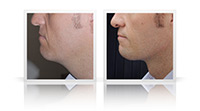 Anterior necklift, liposuction to jawline.