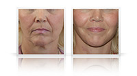 Secondary facelift, Neck lift.