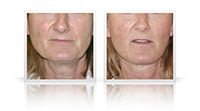 Facelift, neck lift, endoscopic browlift.