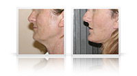 Facelift, neck lift, endoscopic browlift.