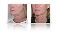 Facelift with neck lift and small fat transfer to midface.