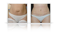 Abdominoplasty umbilical hernia mesh repair.