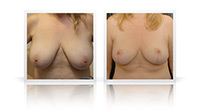 Reduction mammoplasty.