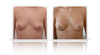 Breast augmentation, cohesive gel implants.