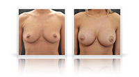 Breast enlargement, areolar scar area.