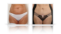 Abdominoplasty, VASER liposelection.