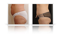 Abdominoplasty, VASER liposelection.