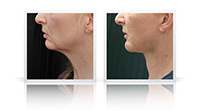 Neck Lift, chin implant.