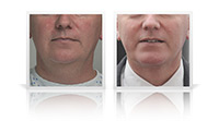 Anterior neck lift, chin implant.