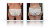Bodytite liposuction.