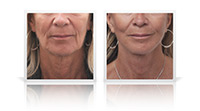 Face and Neck Lift
