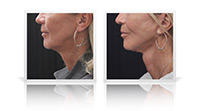 Face and Neck Lift