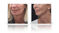 Face and Neck Lift