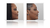 Ethnic rhinoplasty.