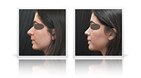 Open-tip reduction rhinoplasty.