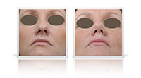 Open-tip reduction rhinoplasty.