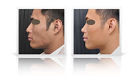 Primary ethnic rhinoplasty.