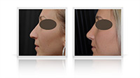 Tertiary open tip rhinoplasty following to primary interventions.