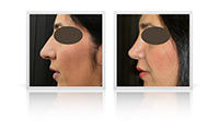Primary open tip reduction rhinoplasty for correction of the nasal tip width